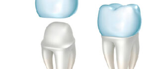 Революция в стоматологии: почему циркониевые коронки стали выбором №1