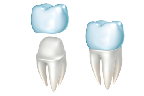 Революция в стоматологии: почему циркониевые коронки стали выбором №1